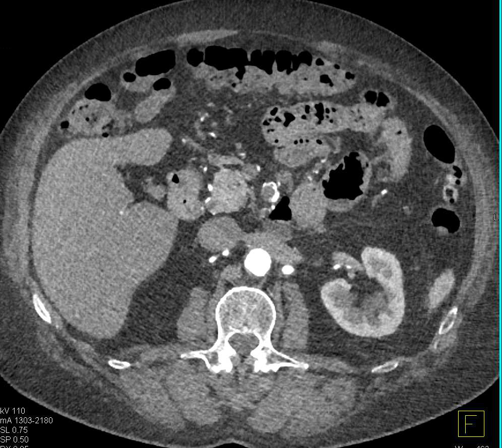 Aneurysm off a Branch of the Superior Mesenteric Artery (SMA) - CTisus CT Scan