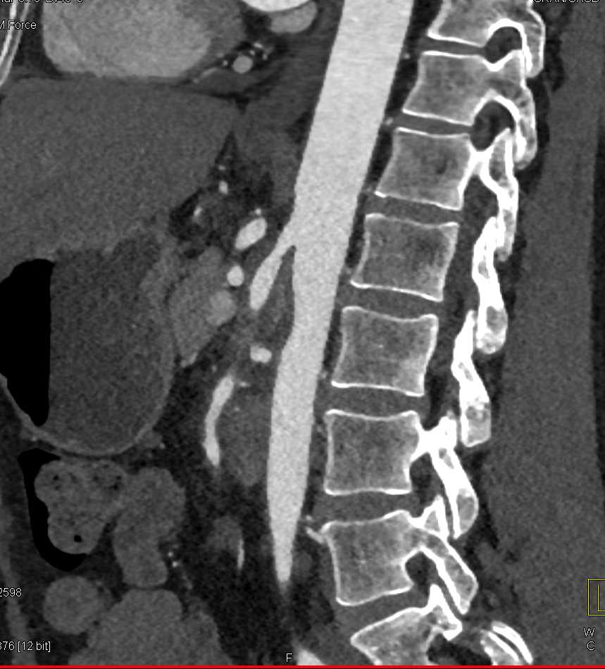 Vasculitis Involving the Superior Mesenteric Artery (SMA) - CTisus CT Scan