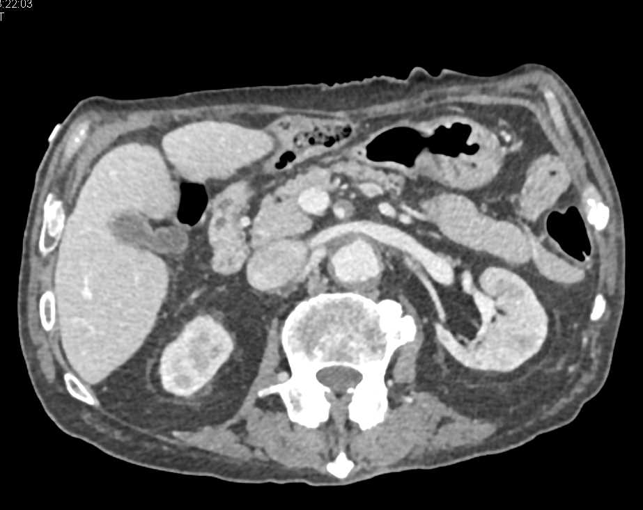 Vasculitis with Thickening of the Superior Mesenteric Artery (SMA) - CTisus CT Scan