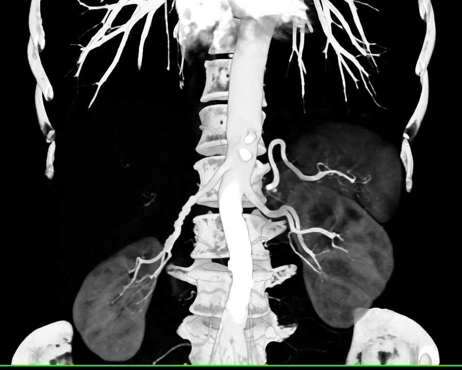 Fibromuscular Dysplasia (FMD) of the Right Renal Artery - CTisus CT Scan