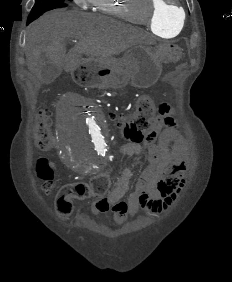 Type 2 Endoleak - CTisus CT Scan