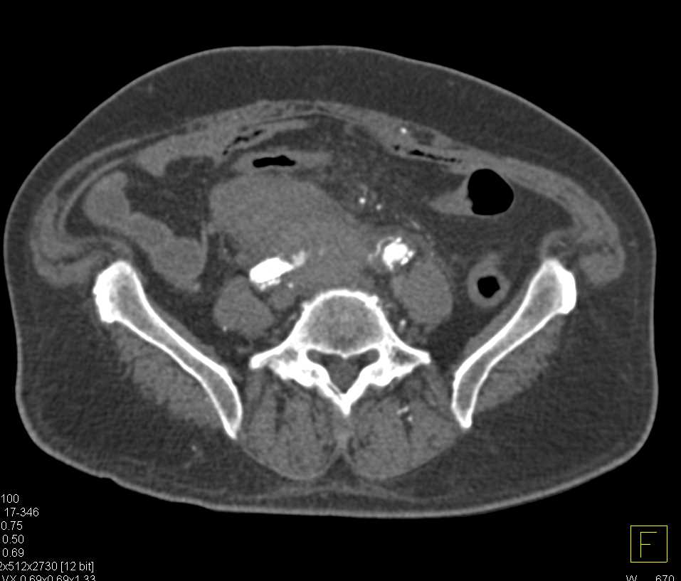 Leaking Aortic Aneurysm - CTisus CT Scan