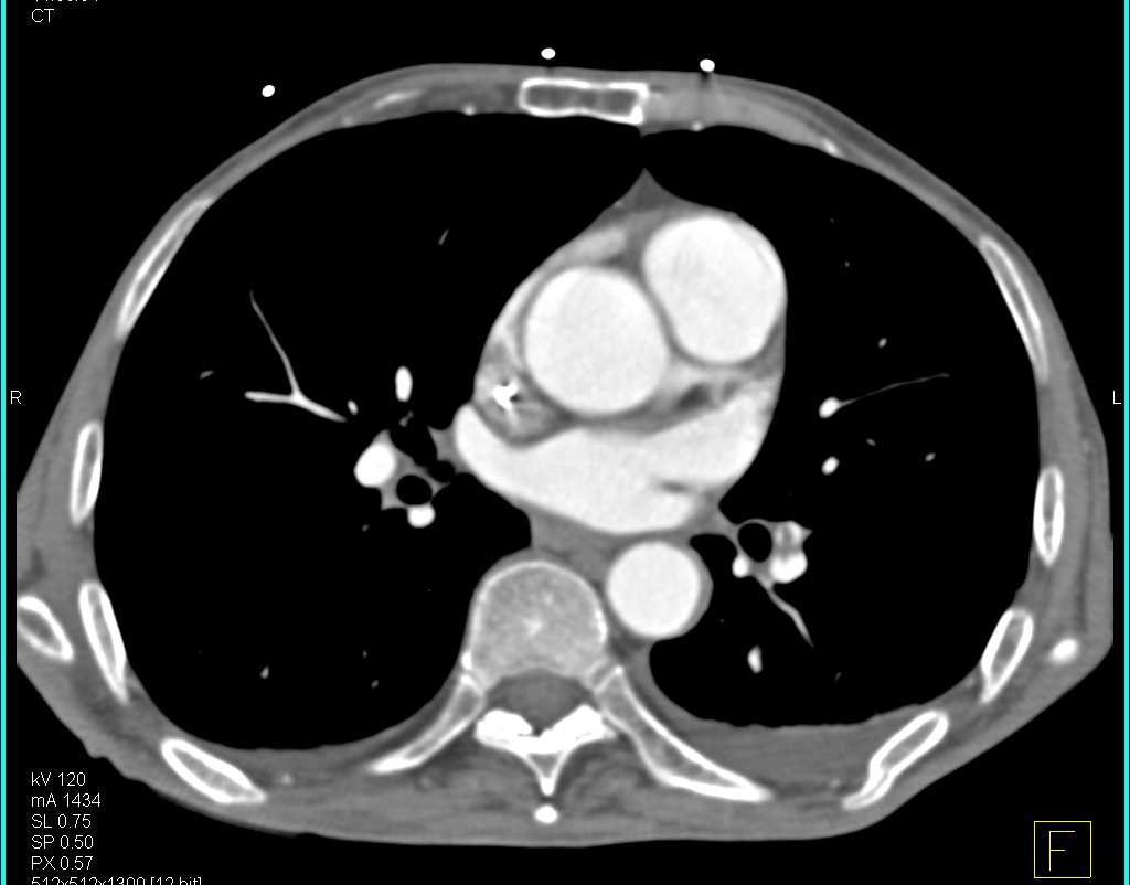 Pulmonary Embolism (PE) and Clot in the Abdominal Aorta - CTisus CT Scan