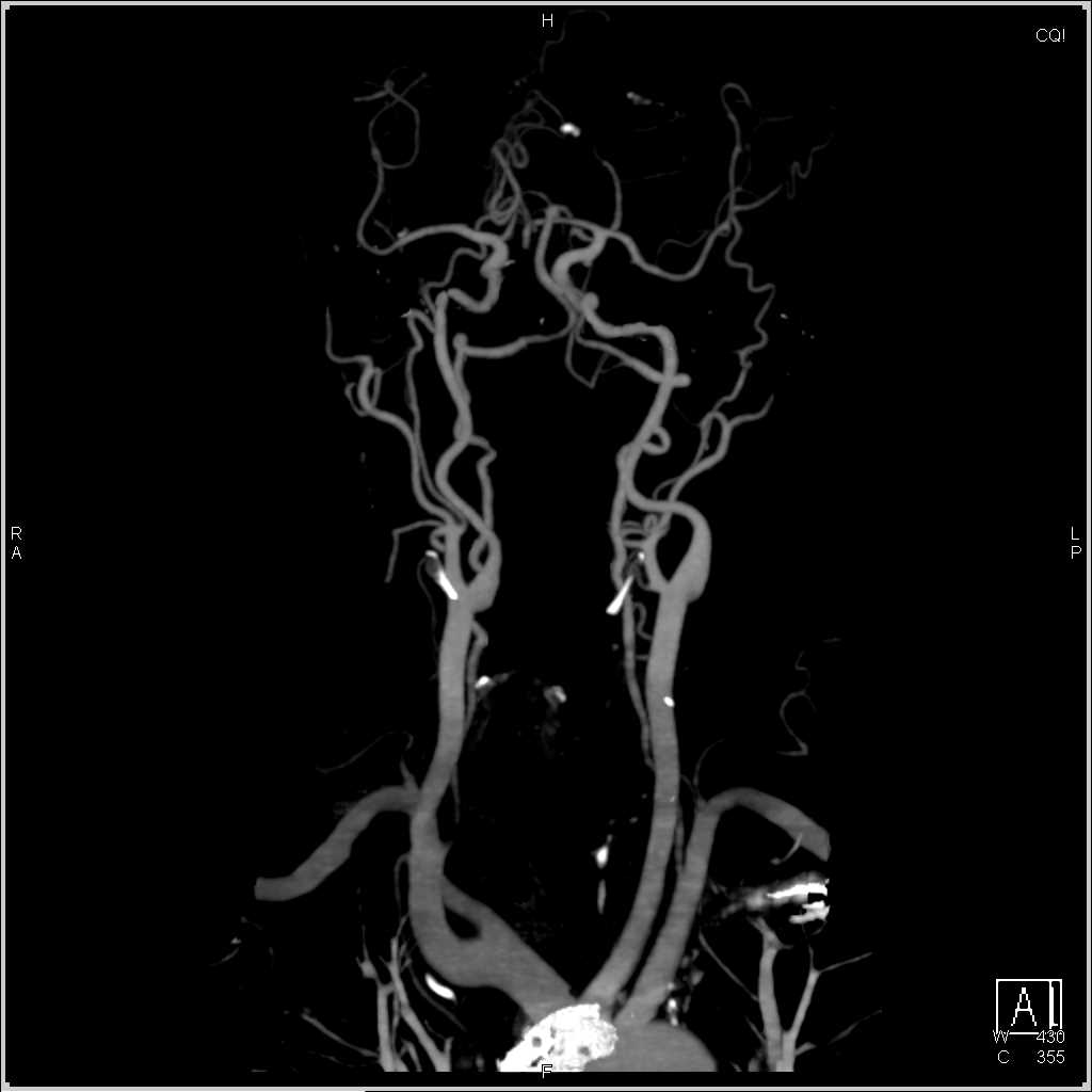 Patent Carotid Arteries - CTisus CT Scan