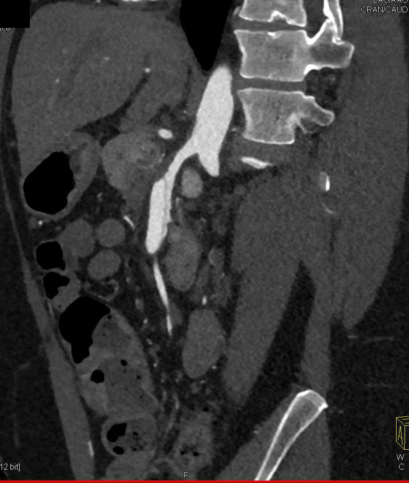 Superior Mesenteric Artery (SMA) dissection - CTisus CT Scan