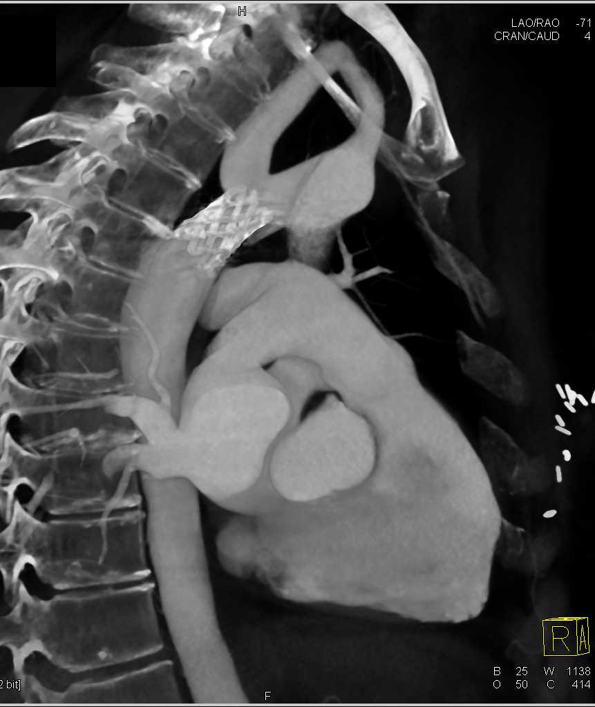 Stent for Coarctation Repair - CTisus CT Scan