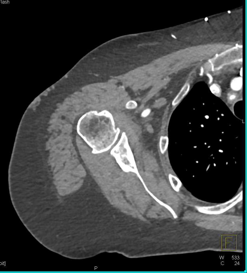 Radial Artery Occlusion - CTisus CT Scan