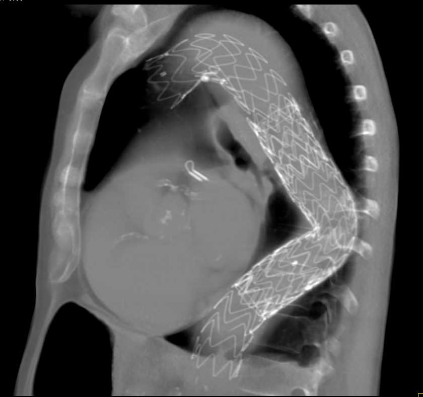 Endovascular Stent in Thoracic Aorta - CTisus CT Scan