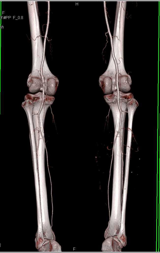 CTA with Normal Runoff Study with Bone Removal - CTisus CT Scan