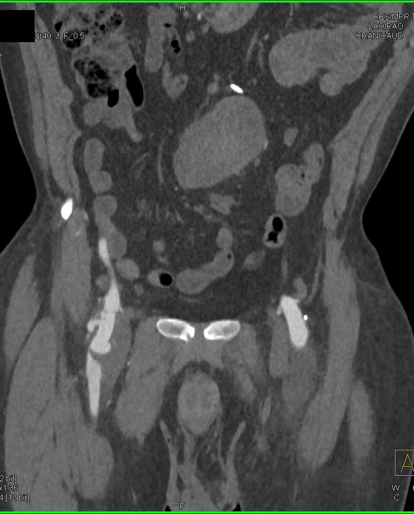 Ulcerations Right Superficial Femoral Artery (SFA) with Pseudoaneurysm - CTisus CT Scan