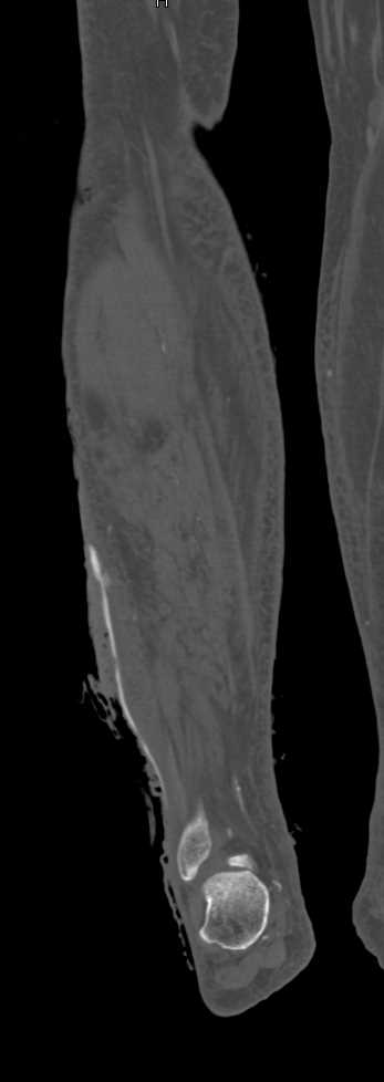 Ulcerations Posterior Tibia Artery - CTisus CT Scan