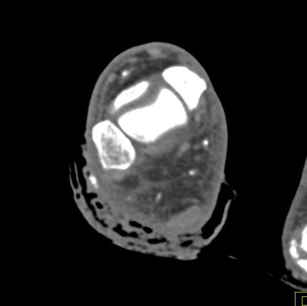 Ulcerations Posterior Tibia Artery with Soft Tissue Injury - CTisus CT Scan