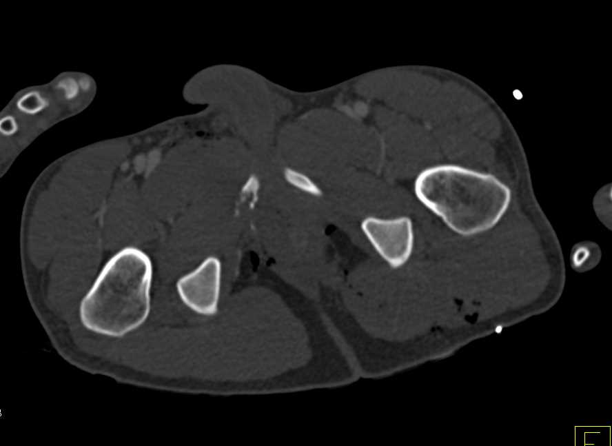 CTA Vascular Mapping for Pre-Op Planning - CTisus CT Scan