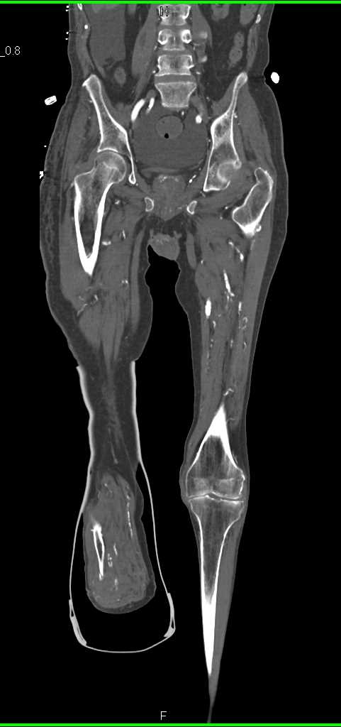 CTA with Peripheral Vascular Disease (PVD) but Vessel Patency - CTisus CT Scan