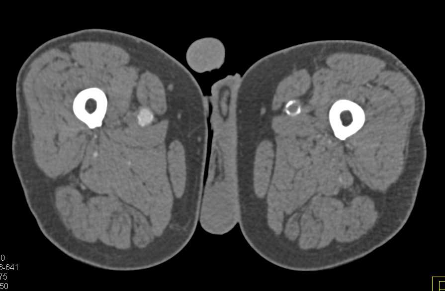 Peripheral Vascular Disease (PVD) with Occluded Left Superficial Femoral Artery (SFA) - CTisus CT Scan