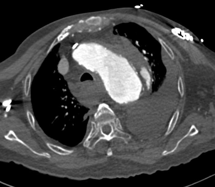 Type B Dissection with Active Contrast Extravasation - CTisus CT Scan