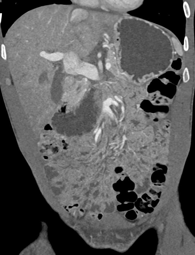 Superior Mesenteric Artery (SMA) Syndrome with Dilated Duodenum - CTisus CT Scan