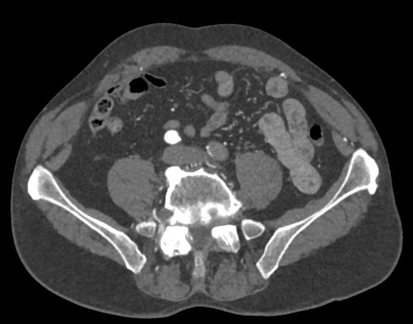 Occluded Left Common Iliac Artery by Clot - CTisus CT Scan