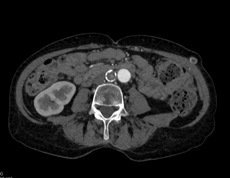 CTA Runoff with Occluded Graft to Left Circulation - CTisus CT Scan