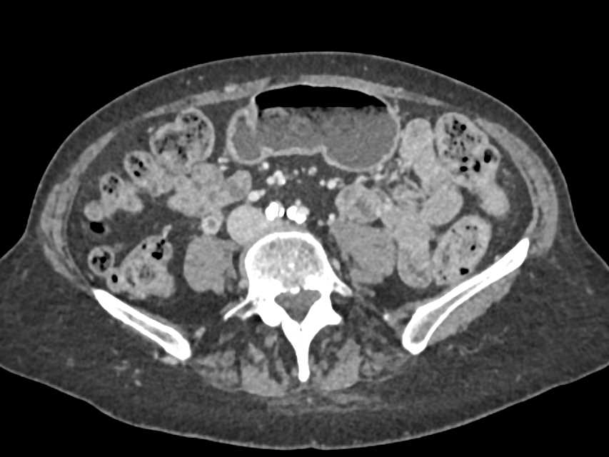 Right Gonadal Vein Thrombus - CTisus CT Scan