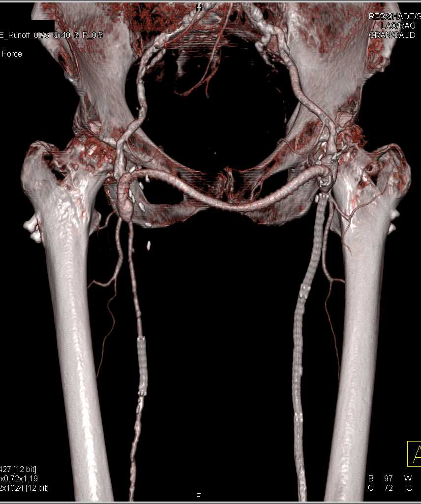 Peripheral Vascular Disease (PVD) with Fem-Fem Bypass and Stents - CTisus CT Scan