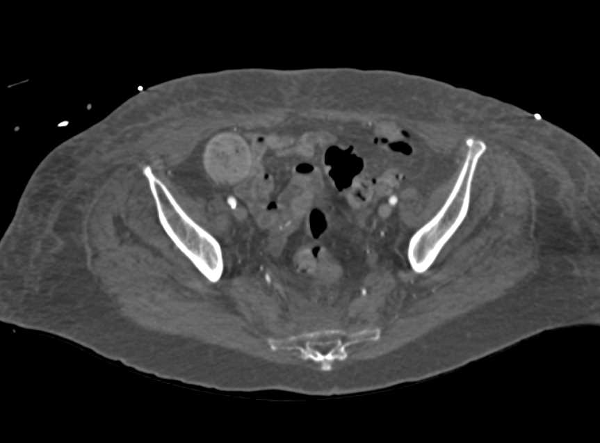 Narrow Caliber Vessels and Peripheral Vascular Disease (PVD) - CTisus CT Scan