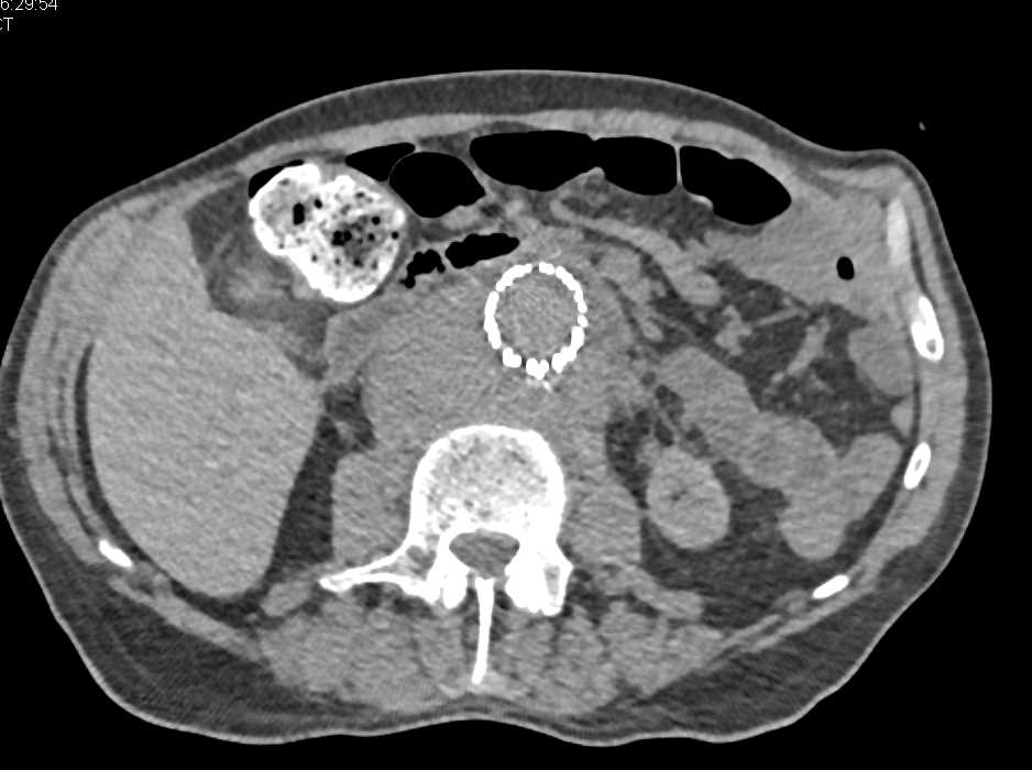 Soft Tissue Tumor Surrounds the Aorta - CTisus CT Scan