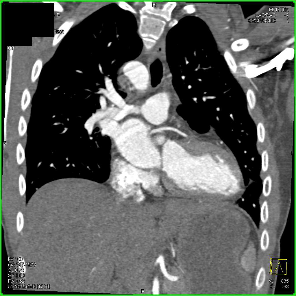 Artifact in the Aorta - CTisus CT Scan