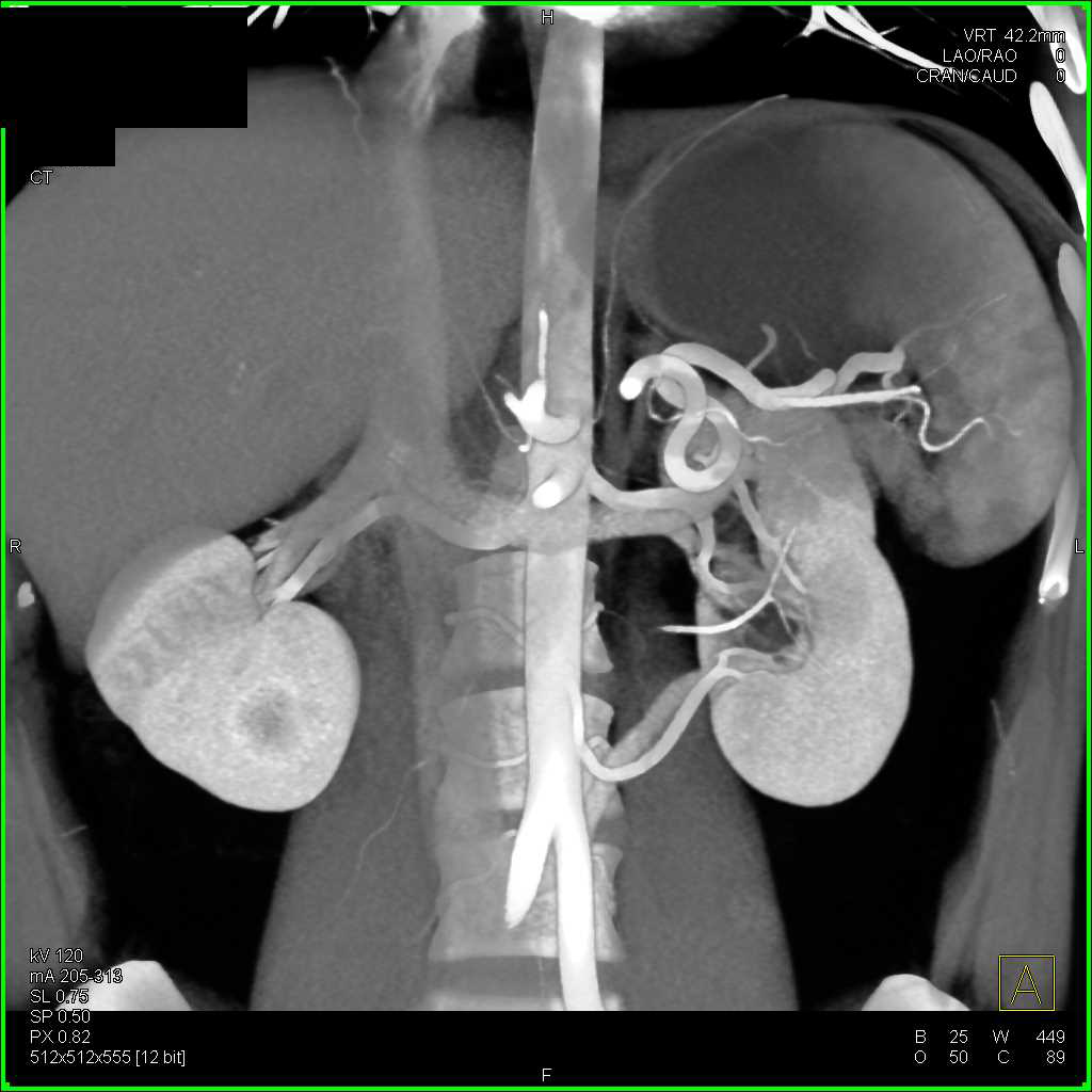 Vascular Map with 2 Left Renal Arteries - CTisus CT Scan