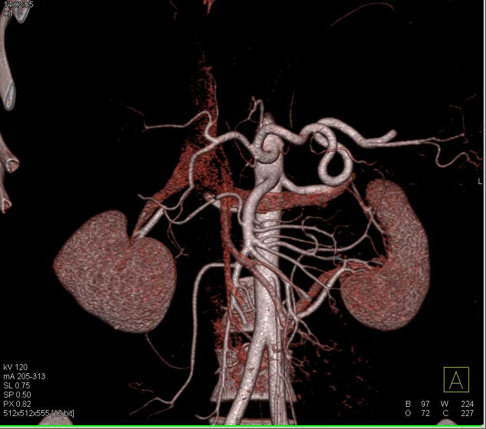Vascular Map with 2 Left Renal Arteries - CTisus CT Scan