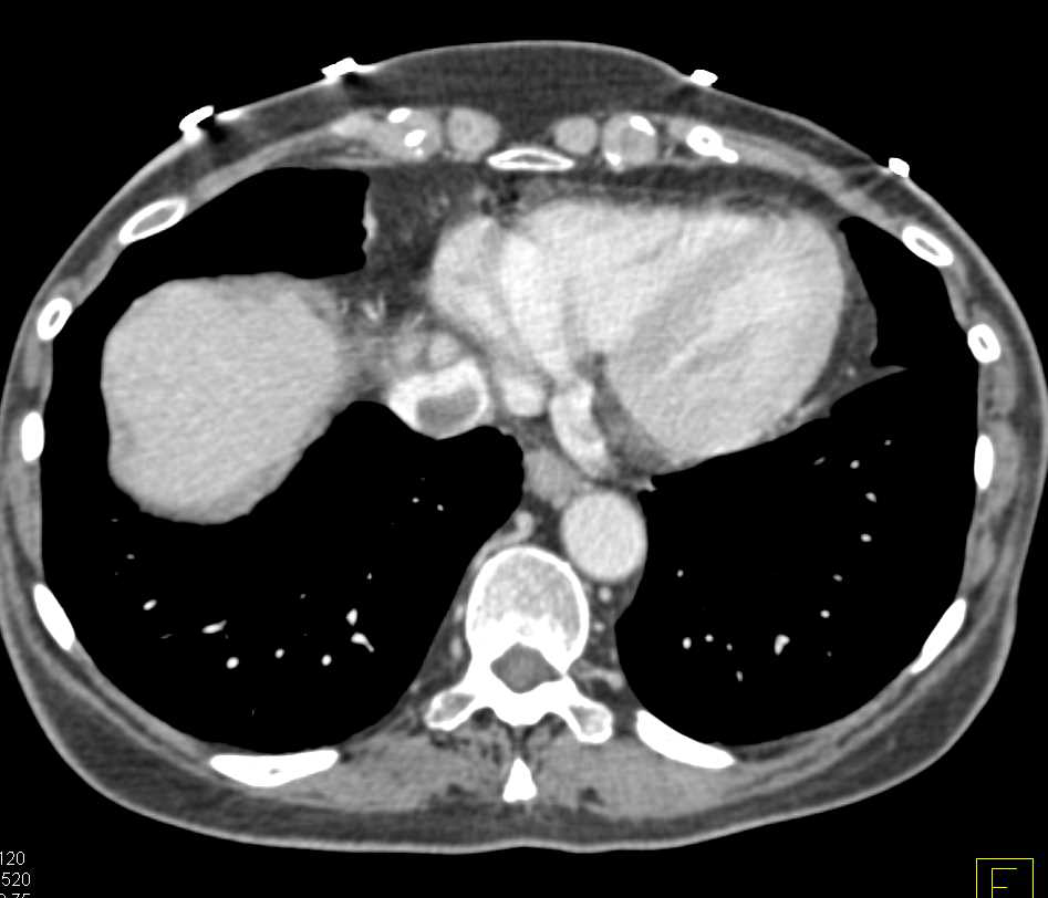 Inferior Vena Cava (IVC) Clot - CTisus CT Scan