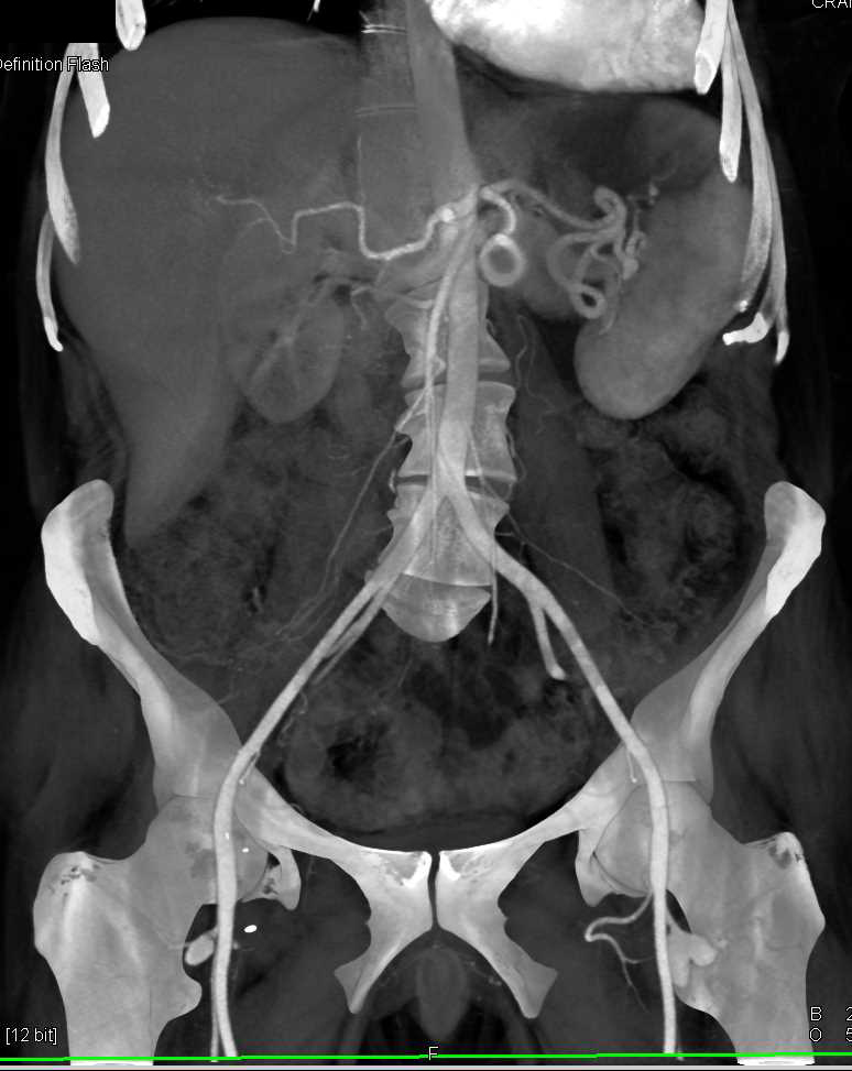 Aneurysms off the Femoral Arteries - CTisus CT Scan