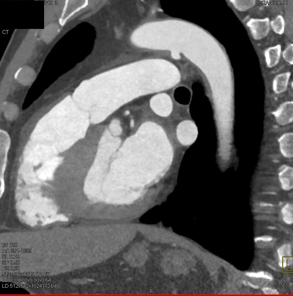 Focal Ductal Aneurysm off the Arch - CTisus CT Scan