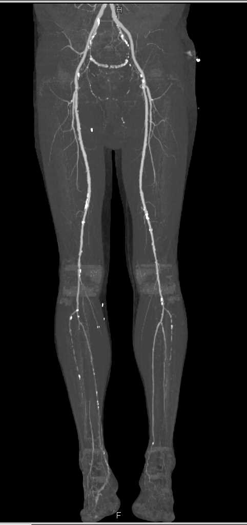 CTA Runoff with Peripheral Vascular Disease (PVD) - CTisus CT Scan