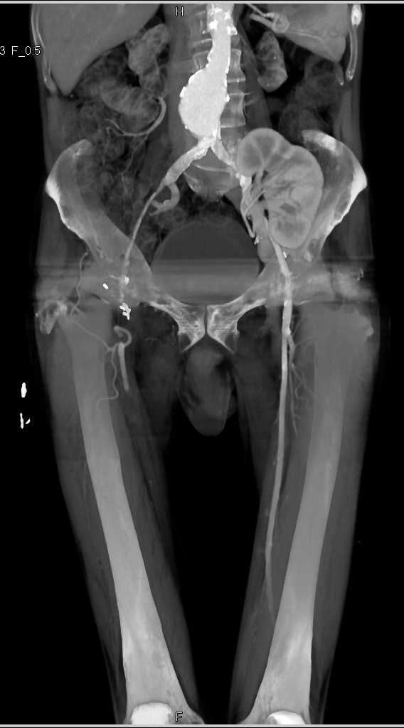 Peripheral Vascular Disease (PVD) with Occluded Right Superficial Femoral Artery (SFA) - CTisus CT Scan