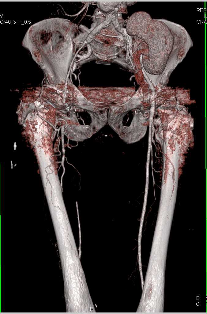 Peripheral Vascular Disease (PVD) with Occluded Right Superficial Femoral Artery (SFA) - CTisus CT Scan