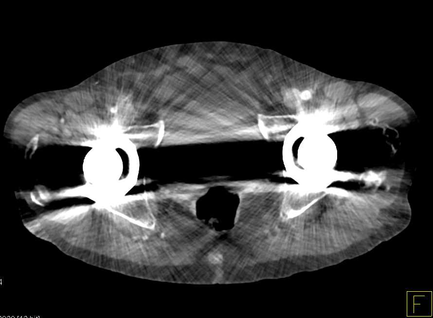 Peripheral Vascular Disease (PVD) with Occluded Right Superficial Femoral Artery (SFA) - CTisus CT Scan