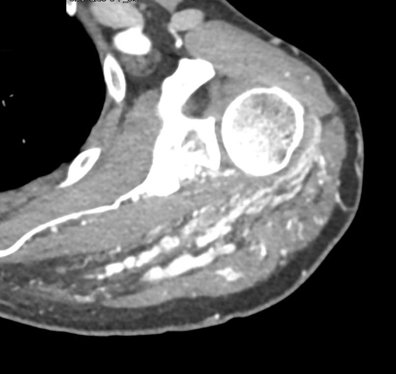 AV Malformation Left Shoulder - CTisus CT Scan