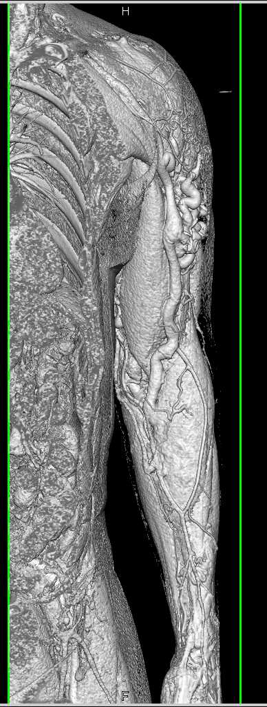 AV Malformation Left Shoulder - CTisus CT Scan