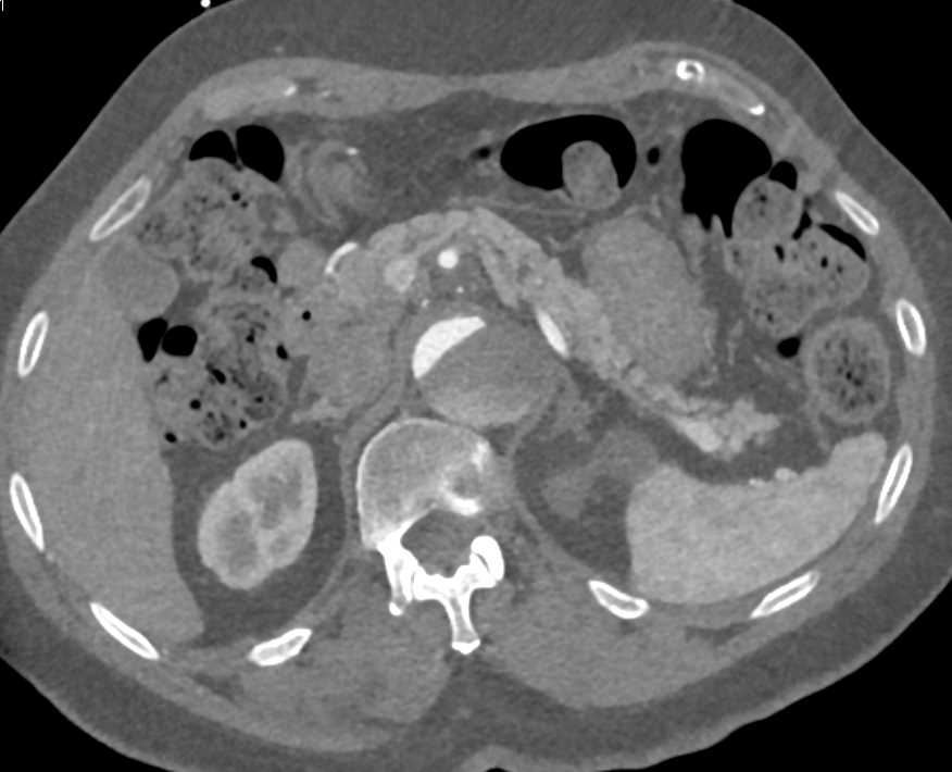 Aortic Dissection with Involvement of the Left Renal Artery - CTisus CT Scan