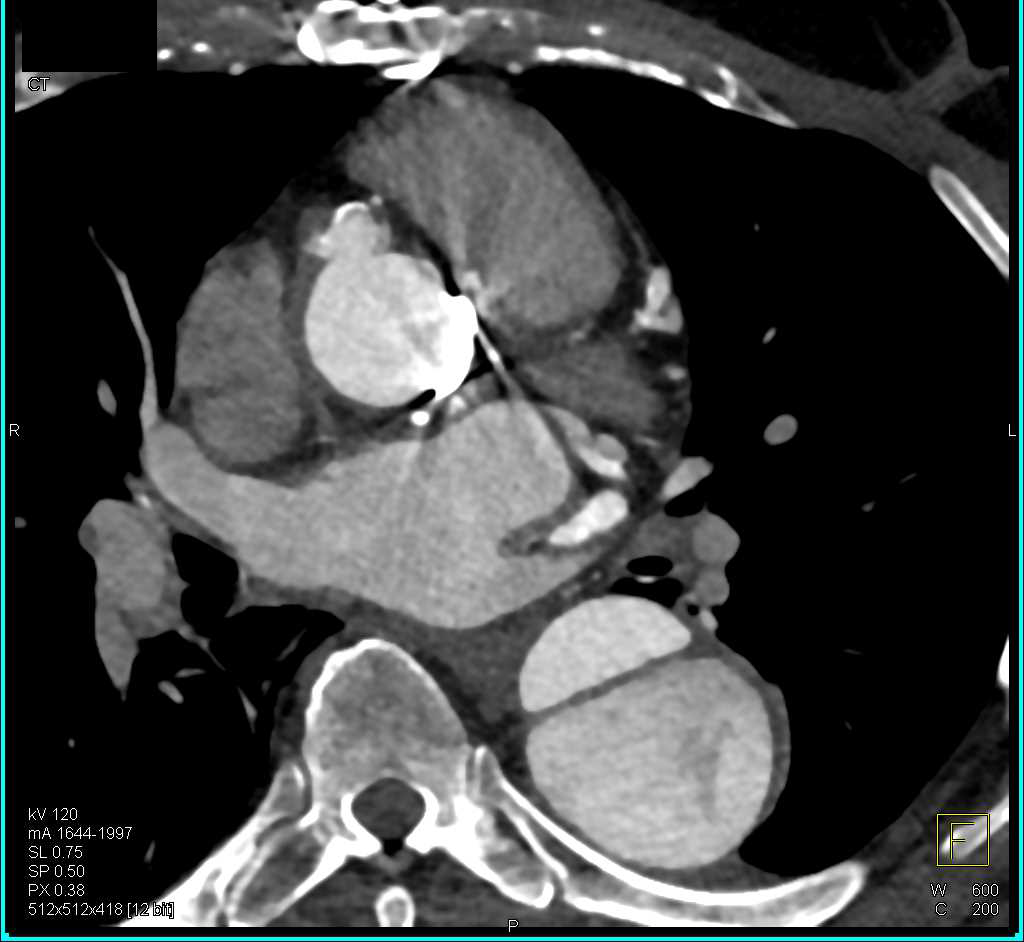 Type B Dissection - CTisus CT Scan