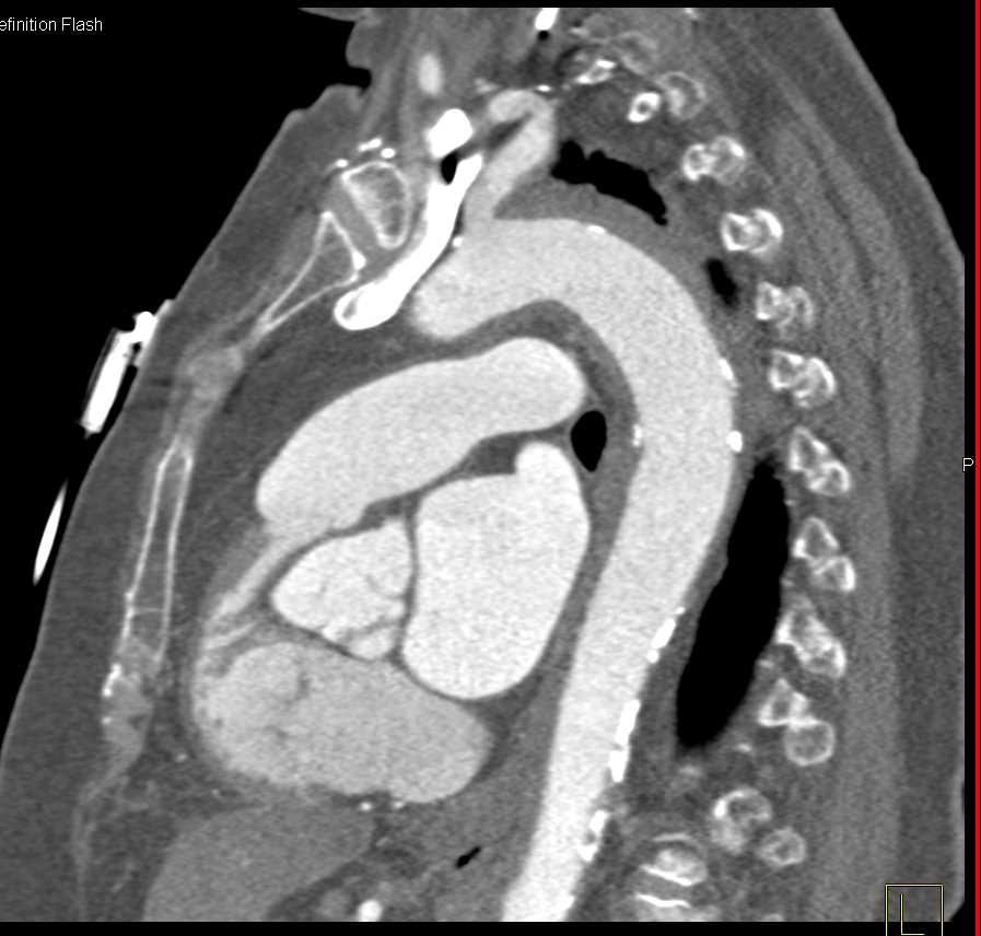 Intramural Hematoma Descending Aorta - CTisus CT Scan