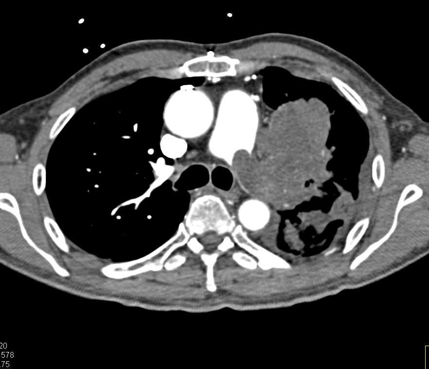 Pulmonary Artery Sarcoma - CTisus CT Scan