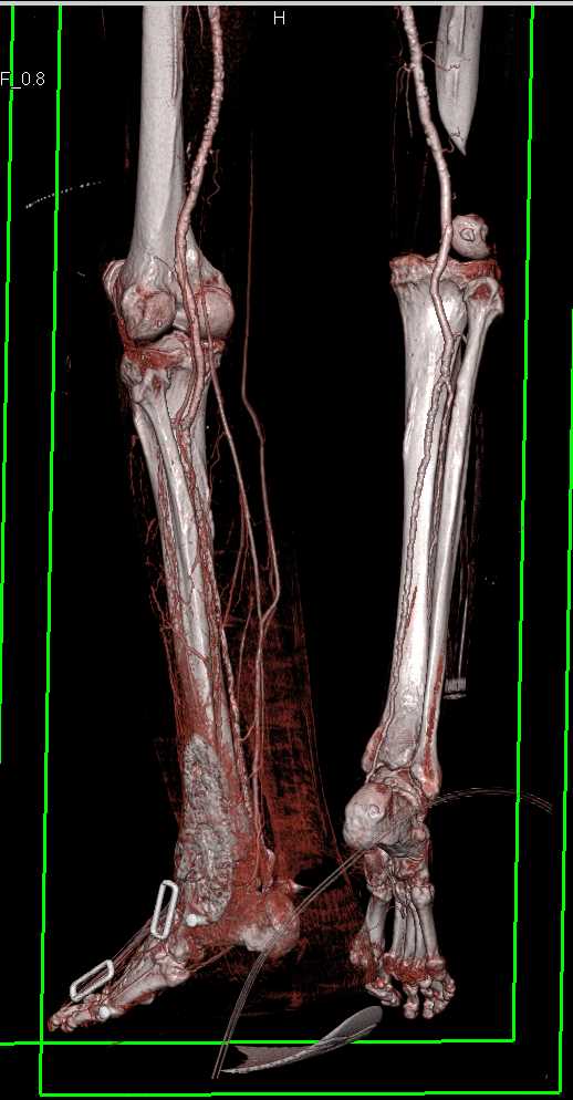 CTA Runoff with Peripheral Vascular Disease (PVD) - CTisus CT Scan