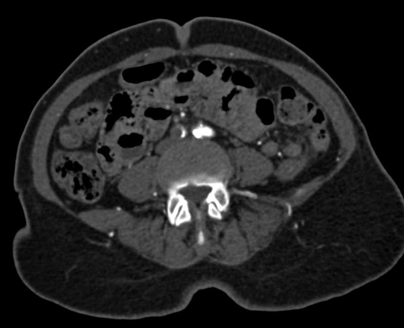 Occluded Right Common Iliac Artery with Collaterals and Peripheral Vascular Disease (PVD) - CTisus CT Scan