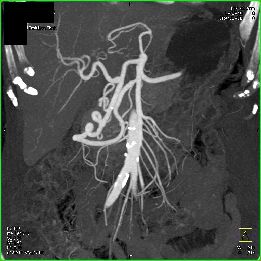 Celiac Stenosis with Flow Through Gastroduodenal Artery (GDA) to Hepatic Artery - CTisus CT Scan