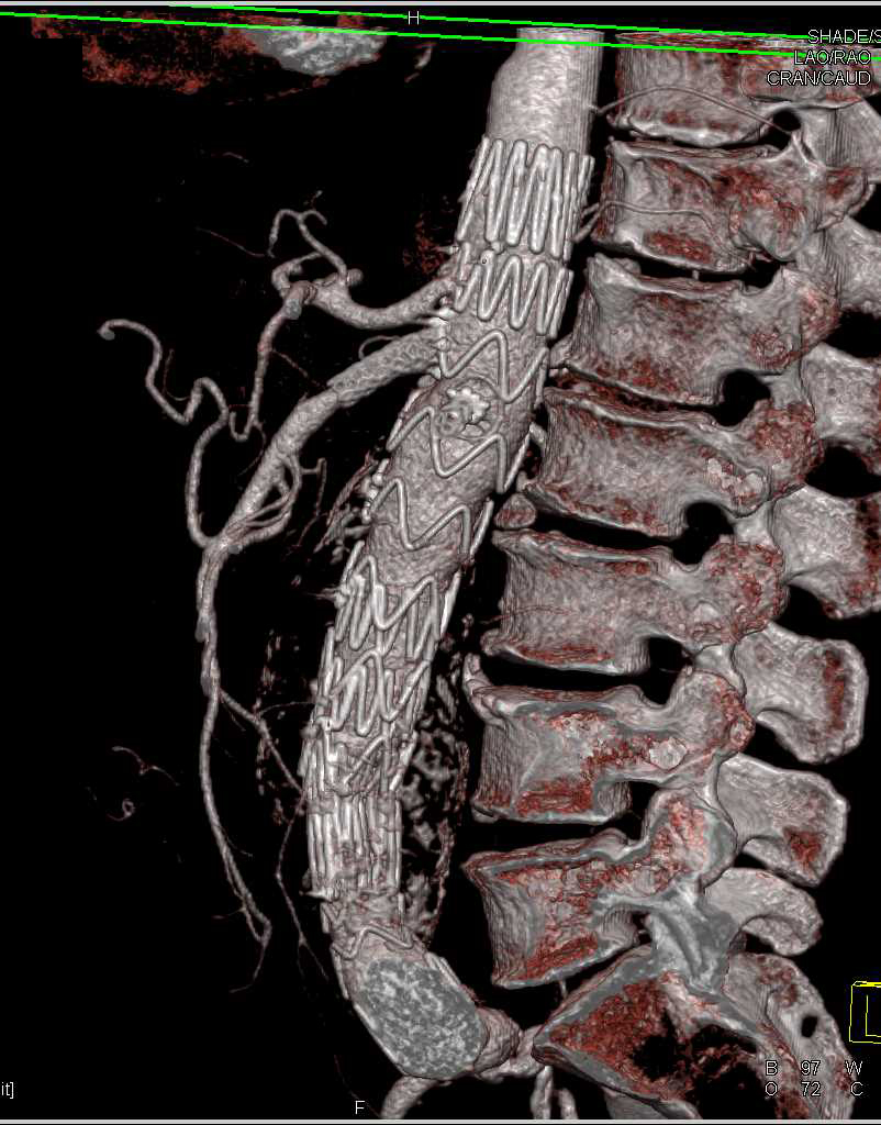 Occluded Stent in Left Renal Artery with Renal Infarcts - CTisus CT Scan
