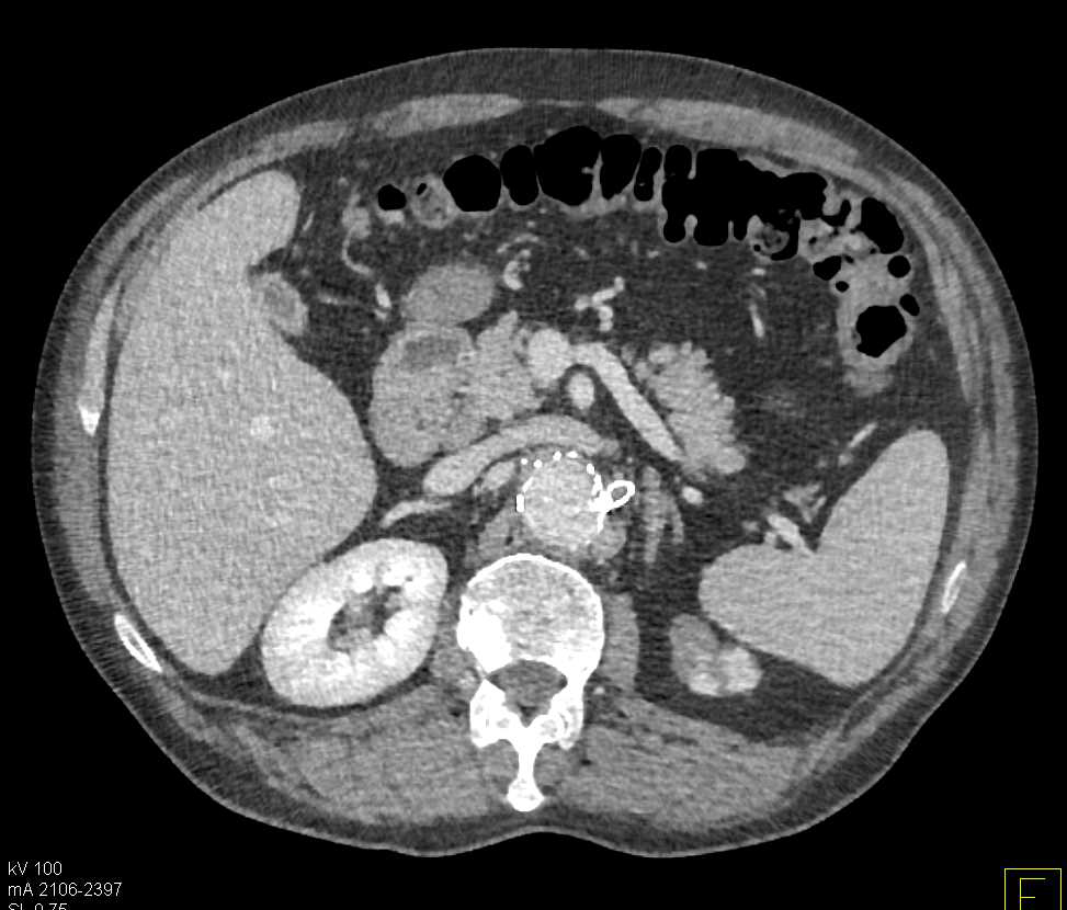 Occluded Stent in Left Renal Artery with Renal Infarcts - CTisus CT Scan
