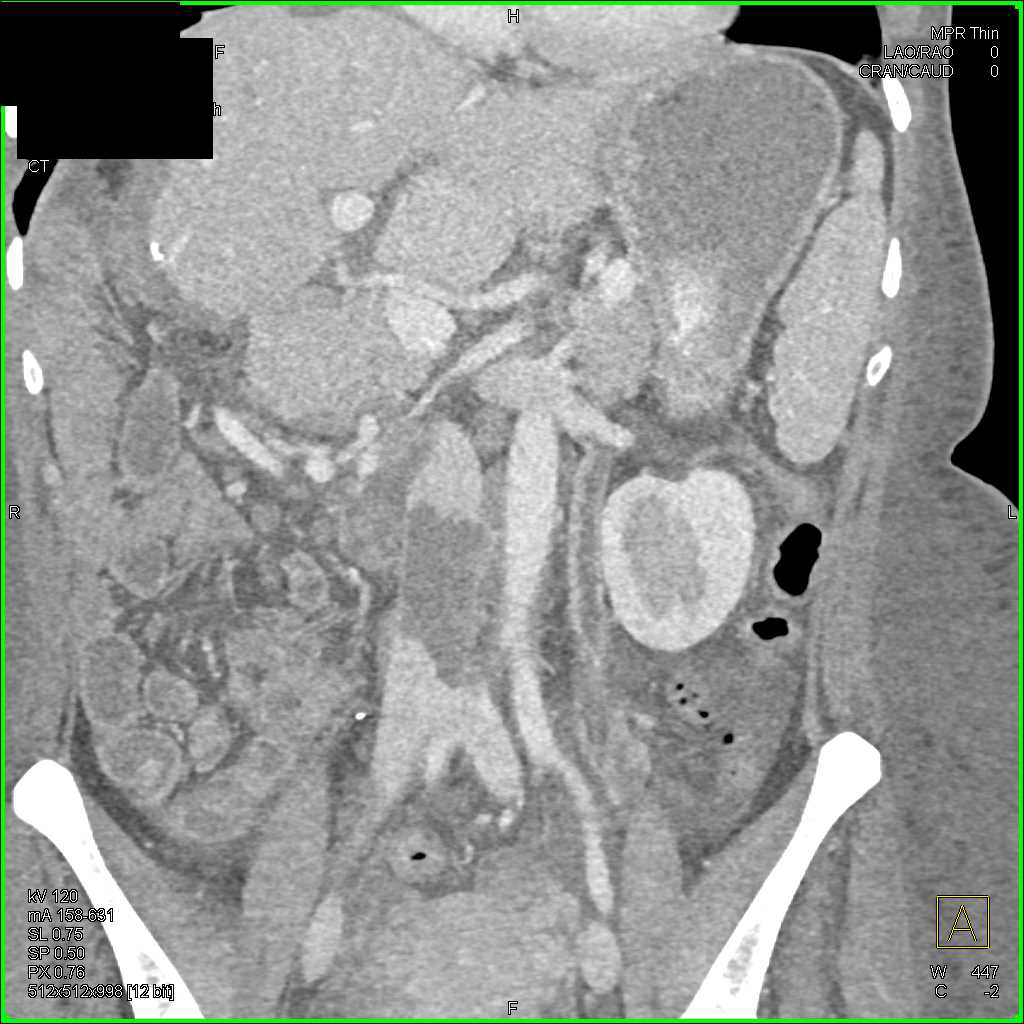 Hepatic Resection and Inferior Vena Cava (IVC) Thrombus - CTisus CT Scan