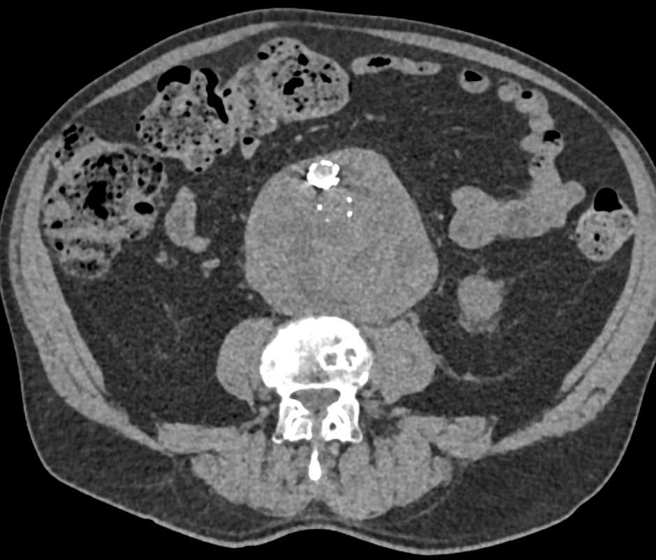 Abdominal Aortic Aneurysm (AAA) with Endovascular Repair and Type II Endoleak - CTisus CT Scan